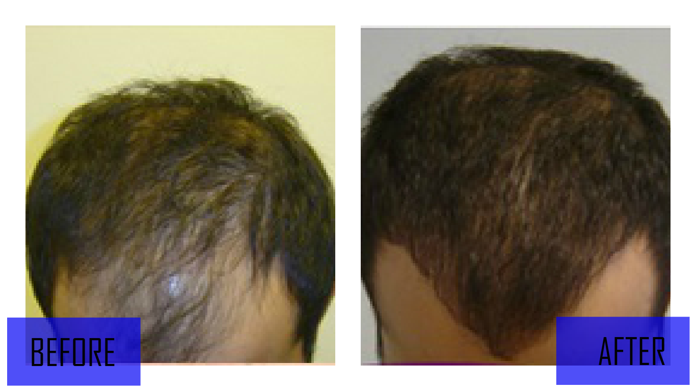Before and After Photos Hair Transplant Mexico