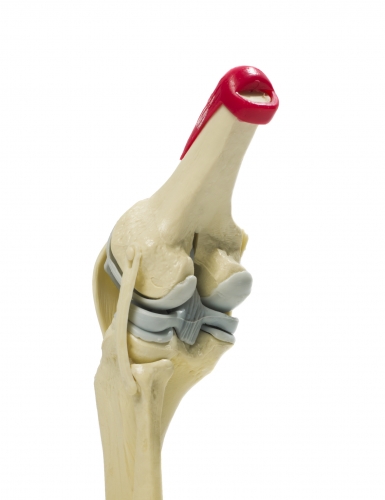 Computer Assisted Knee Replacement Knee Replacement