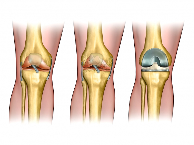 Cemented and Cementless Knee Replacement | Knee Replacement Surgery in